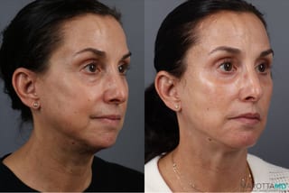 Before and after Fat Transfer - Face case 41866 - Angle 2