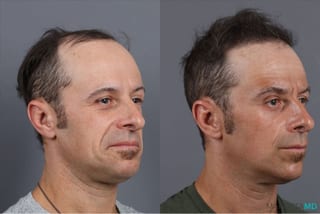 Before and after PRP Scalp Treatment case 41865 - Angle 2