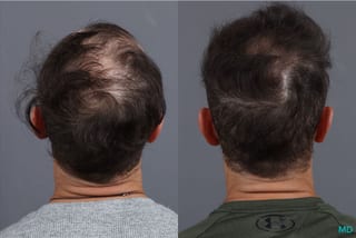 Before and after PRP Scalp Treatment case 41865 - Angle 4