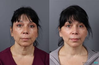 Before and after Mini Facelift case 43162 - Angle 1