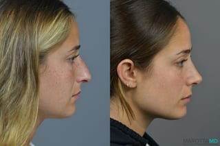 Before and after Rhinoplasty case 41923 - Angle 5