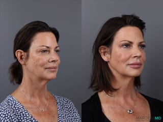 Before and after Filler - Cheek case 21525 - Angle 3