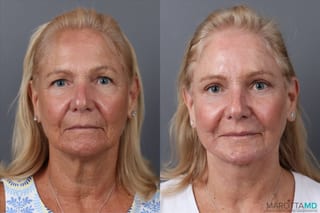 Before and after Endoscopic Brow Lift case 43233 - Angle 1