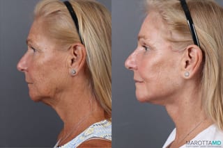 Before and after Endoscopic Brow Lift case 43233 - Angle 5
