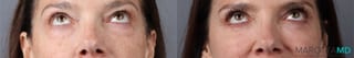 Before and after Blepharoplasty Lower case 43416 - Angle 1