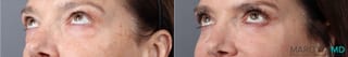 Before and after Blepharoplasty Lower case 43416 - Angle 2