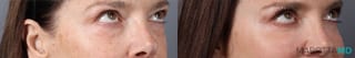 Before and after Blepharoplasty Lower case 43416 - Angle 3