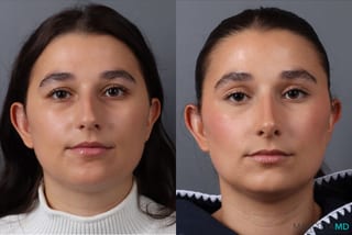 Before and after Rhinoplasty case 43704 - Angle 1