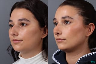 Before and after Rhinoplasty case 43704 - Angle 4
