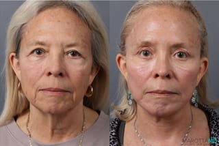 Before and after Facelift & Neck Lift case 43705 - Angle 1