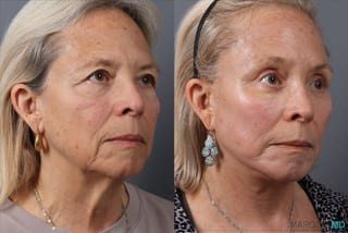 Before and after Facelift & Neck Lift case 43705 - Angle 2
