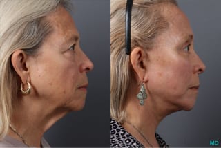 Before and after Facelift & Neck Lift case 43705 - Angle 3