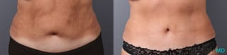 Before and after Abdominoplasty case 41920 - Angle 1