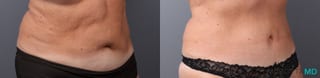Before and after Abdominoplasty case 41920 - Angle 2