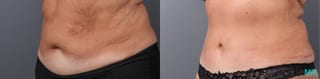 Before and after Abdominoplasty case 41920 - Angle 4