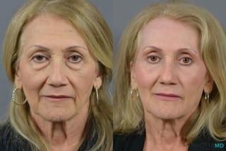 Before and after Blepharoplasty case 6988 - Angle 1