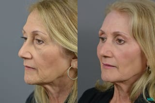 Before and after Blepharoplasty case 6988 - Angle 2