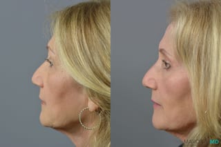 Before and after Blepharoplasty case 6988 - Angle 3