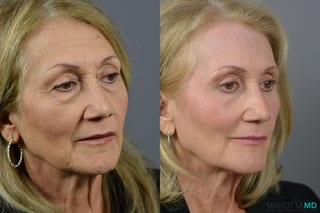 Before and after Blepharoplasty case 6988 - Angle 4