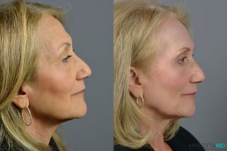 Before and after Blepharoplasty case 6988 - Angle 5