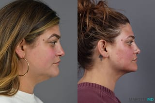Before and after Renuvion case 6990 - Angle 3