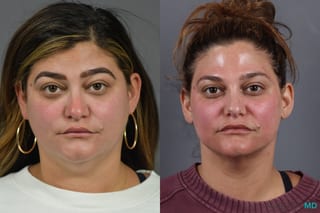 Before and after Liposuction of the Neck case 6991 - Angle 1