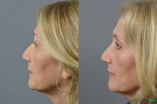 Before and after Laser Skin Resurfacing - Face case 6992 - Angle 3