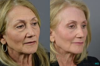 Before and after Laser Skin Resurfacing - Face case 6992 - Angle 4