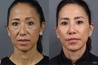 Before and after Mini Facelift case 6994 - Angle 1