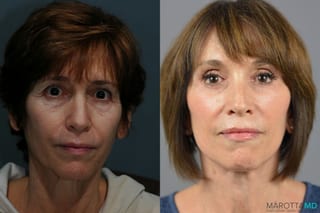 Before and after Facelift & Neck Lift case 6996 - Angle 1