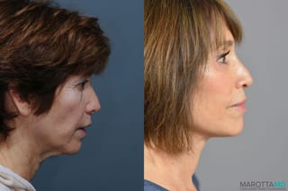 Before and after Facelift & Neck Lift case 6996 - Angle 2