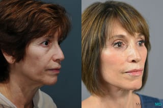 Before and after Facelift & Neck Lift case 6996 - Angle 3