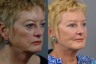 Before and after Facelift & Neck Lift case 7005 - Angle 3
