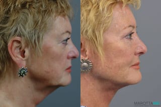 Before and after Facelift & Neck Lift case 7005 - Angle 4