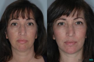 Before and after Liposuction of the Neck case 7020 - Angle 1