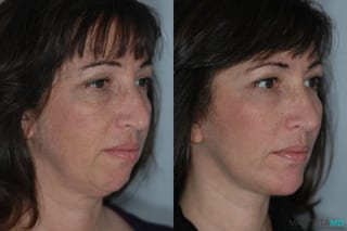 Before and after Liposuction of the Neck case 7020 - Angle 2