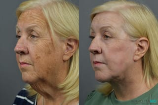 Before and after Laser Skin Resurfacing - Face case 7021 - Angle 2