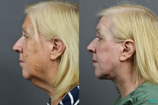 Before and after Laser Skin Resurfacing - Face case 7021 - Angle 3