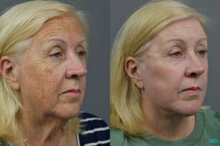 Before and after Laser Skin Resurfacing - Face case 7021 - Angle 4