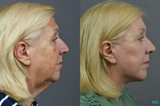 Before and after Laser Skin Resurfacing - Face case 7021 - Angle 5