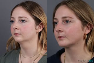 Before and after Liposuction of the Neck case 7031 - Angle 2