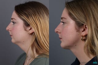 Before and after Liposuction of the Neck case 7031 - Angle 3