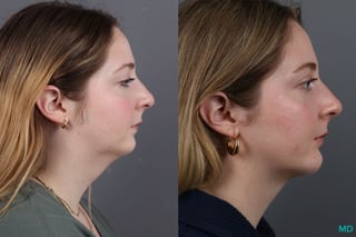 Before and after Liposuction of the Neck case 7031 - Angle 4