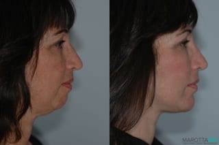 Before and after Chin Implant case 7033 - Angle 3