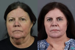 Before and after Facelift & Neck Lift case 7034 - Angle 1