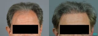 Before and after Hair Transplantation case 7048 - Angle 1