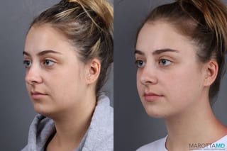 Before and after Liposuction of the Neck case 7051 - Angle 4