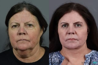 Before and after Blepharoplasty case 7078 - Angle 1