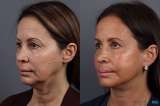 Before and after Facelift & Neck Lift case 7092 - Angle 4