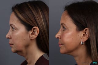 Before and after Facelift & Neck Lift case 7092 - Angle 5